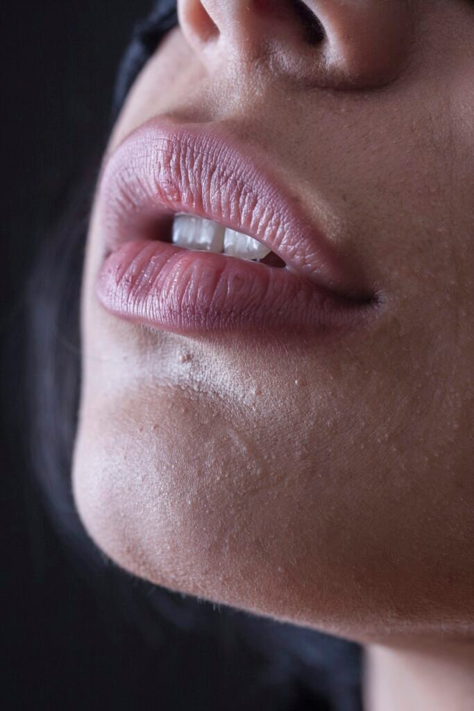 Natuurlijk volle lippen na hyaluronzuur boosters bij S.W Clinic Veenendaal